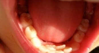 Impianti dentali vivi che crescono direttamente in bocca