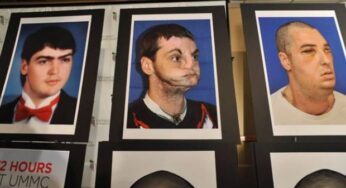Il trapianto facciale più complicato del mondo e il volto ritrovato di Richard Lee Norris