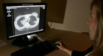 Cinque cose da sapere sul cancro ai polmoni