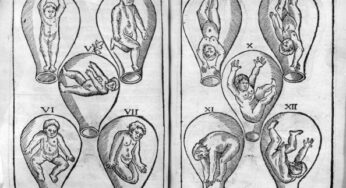 Svezia: partorisce dopo trapianto di utero. Primo caso al mondo