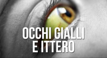 Cos’è l’ittero? Le cause e i trattamenti