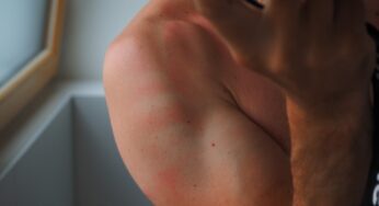 Melanoma: uomini bocciati in materia di prevenzione