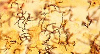 Sifilide: sintomi, cause e cure della malattia sessualmente trasmissibile