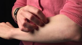 Cos’è l’allergia psicosomatica e come si riconosce