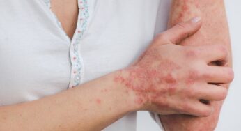 29 ottobre – Giornata Mondiale della Psoriasi