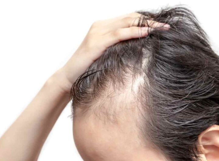 Caduta capelli