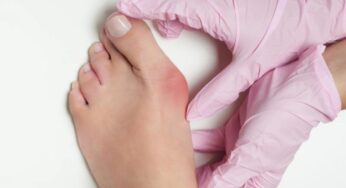 Alluce valgo, come diminuire il fastidio e quando preoccuparsi