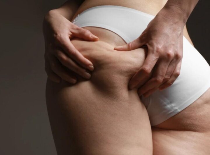 Cellulite addio