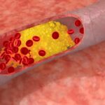 Colesterolo alto, rischi