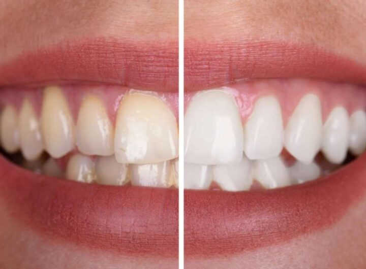 Denti più bianchi