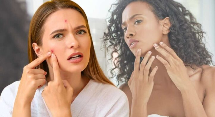 Brufoli, la guida (definitiva) dell’esperto per capire le vere cause ed eliminarli una volta per tutte dal viso