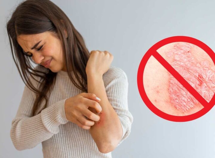 Psoriasi trattamento innovativo