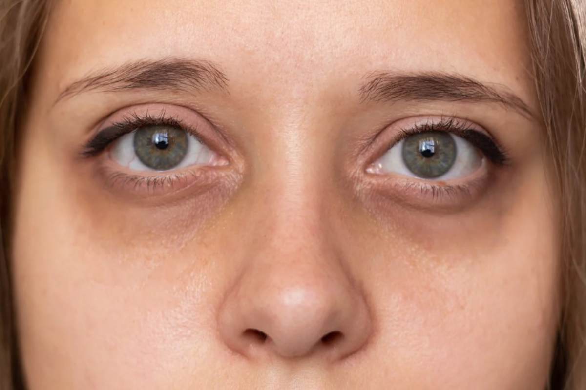 Rimedi contro occhiaie